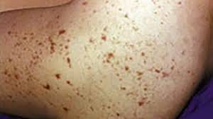 Small spots develop at first and may occur in groups note: Meningitis Pictures Of Rash And Other Symptoms