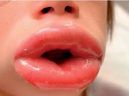 photograph of peri and lip swelling