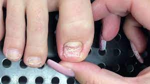 toenail reconstruction with nanoflex by