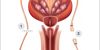 The procedure has few risks. Vasectomy Birth Control Surgery For Men Metromale Clinic Fertility Center