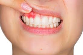 inflammation of the gums detecting and