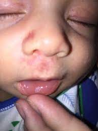 help white spot on baby s lip babycenter