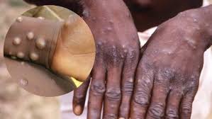 Monkeypox: FG Moves To Stop Spread