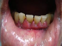 a role for homeopathy in treating gum