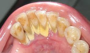 remove tartar from teeth without