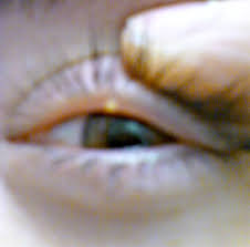 eye eye stye treatment