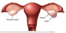 Image result for icd 9 code for ovarian lesion