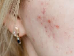 do you have cystic acne problem here