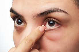Check out the symptoms and follow these remedies to stop eye the sudden twitching of your eyes can mean a number of things. This Is Why Your Eye Won T Stop Twitching The Washington Post