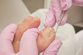 non surgical care of ingrown toenails
