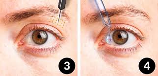 5 solutions for droopy eyelids