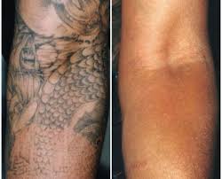 Removal of a tattoo takes time, affords patience, and obviously costs money. Tattoo Removal In Delhi Tattoo Removal Cost Tattoo Removal