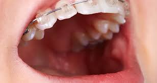 Use an orthodontic floss thread to remove any food or other impurity stuck between your teeth and under the gum line. The Secret To Sleeping Comfortably With Braces