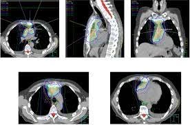 postoperative radiation therapy