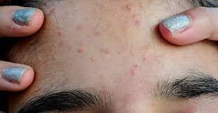 managing itchy acne symptoms causes