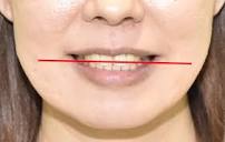 咬合平面の傾斜（cant）、ガタガタ歯、八重歯、口ゴボ、開咬の治療例 ...
