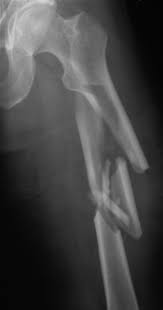 fem shaft fractures trauma