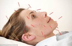 Cosmetic Acupuncture Is The Newest Weapon In The Anti