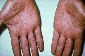 hiv rash vs syphilis rash symptoms