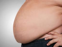 Morbid Obesity Symptoms Treatment And Outlook