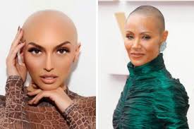 celebrities with alopecia hair loss