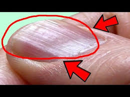 causes ridges in finger and toenails