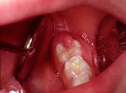 wisdom tooth infection causes