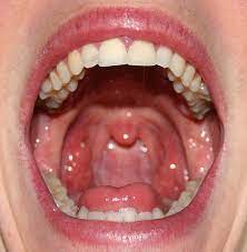 immersion nose mouth throat the