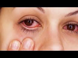 relieve itchy irritated allergy eyes