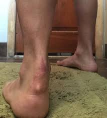 It is a good idea to stop any activity and carry out ricer — rest, ice, compression, elevation and referral. Achilles Rupture Recovery And Now Tendonitis W Cyst Scar Tissue