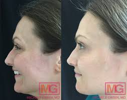 botox for crows feet wrinkle reduction