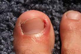 cutting an ingrown toenail