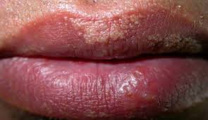 fordyce spots lips removal treatment