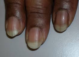 dark lines in nails mdedge family