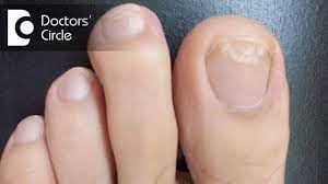 what causes white spots on toenails