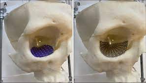 personalized implanted biomaterial for