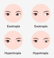 eye gles for strabismus full guide
