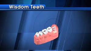 Many people have to have surgery to get rid of them because they often grow in a crooked way. Wisdom Teeth Youtube