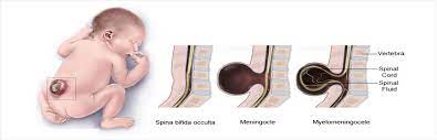 spina bifida sequencing consortium