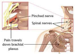 pinched nerve in neck treatment in new