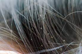 hair dye kills lice
