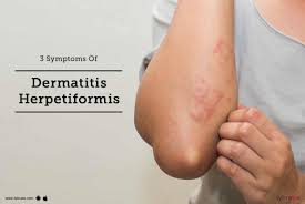 3 symptoms of dermais herpetiformis