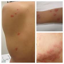 Use the pictures and information below to help you identify bug bites and stings. How To Tell Bed Bug Bites From Flea Bites Sterifab Bed Bug Blog