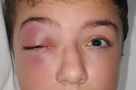 a swollen right eye in a child the bmj