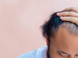 hair loss after weight loss causes