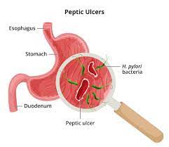 definition facts for peptic ulcers