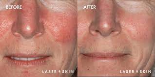 vbeam laser skin pigmentation