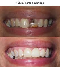 dental bridges benton nelson