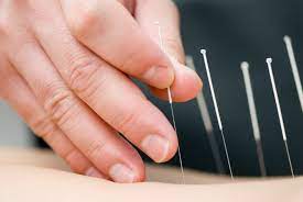 Some states require you to have past work experience as a physician or chiropractor which could influence the educational tract you need to pursue. Acupuncture Collingwood Collaborative Health Group
