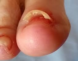 injured toe nail footman podiatry and